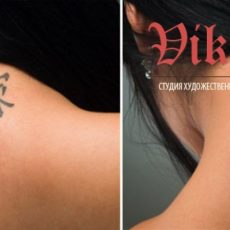 Удаление татуировок: до и после
