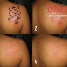 Удаление татуировок: до и после